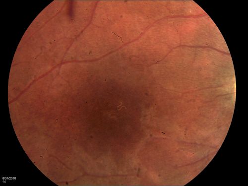 DUSN - Diffuse Unilateral Subacute Neuroretinitis - Nematode

