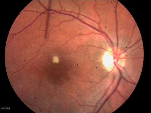 DUSN - Diffuse Unilateral Subacute Neuroretinitis - Nematode
