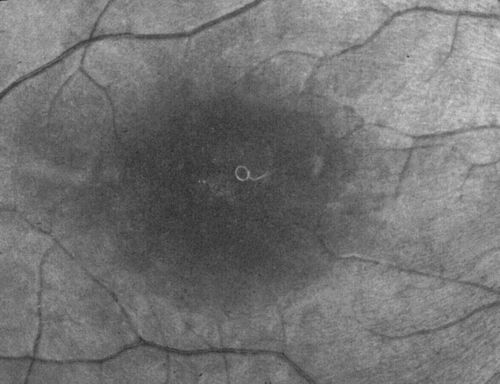 DUSN - Diffuse Unilateral Subacute Neuroretinitis - Nematode
