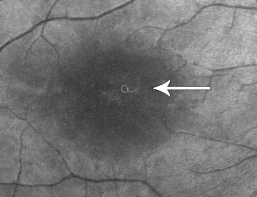 DUSN - Diffuse Unilateral Subacute Neuroretinitis - Nematode
