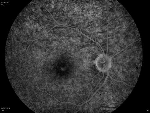 DUSN - Diffuse Unilateral Subacute Neuroretinitis - Nematode
