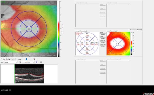 Macular schisis with no leakage on FA - Presumed Nerve pit maculopathy
73-year old female.  Had treatment trial with Eylea with no benefit (4 months).  Vision is 20/32 in left eye and has remained there (with a dense cataract).
