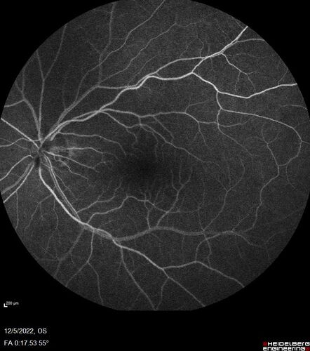 Macular schisis with no leakage on FA - Presumed Nerve pit maculopathy
73-year old female.  Had treatment trial with Eylea with no benefit (4 months).  Vision is 20/32 in left eye and has remained there (with a dense cataract).
