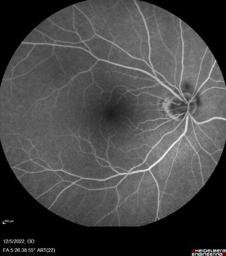 Macular schisis with no leakage on FA - Presumed Nerve pit maculopathy
73-year old female.  Had treatment trial with Eylea with no benefit (4 months).  Vision is 20/32 in left eye and has remained there (with a dense cataract).
