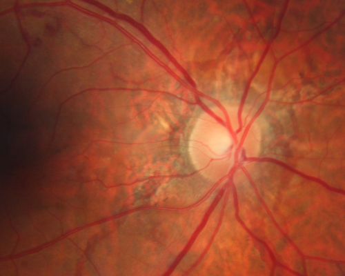 Angioid Streaks New Vision Change in Good Right Eye Treated with Lucentis
53-year-old man has angioid streaks.  He has a macular scar in the left eye from choroidal neovasculari-zation that was treated with photodynamic laser 5-8 years ago.  His vision in the right eye had been fine until about a week ago when he noticed temporally in the right eye an area that does not look normal and looks a little distorted.
VISUAL ACUITY: Vision OD is 20/30, OS is 20/400.  Treatment was started within a month and patient responded well and is now 3 years out requiring every 3 month Lucentis
