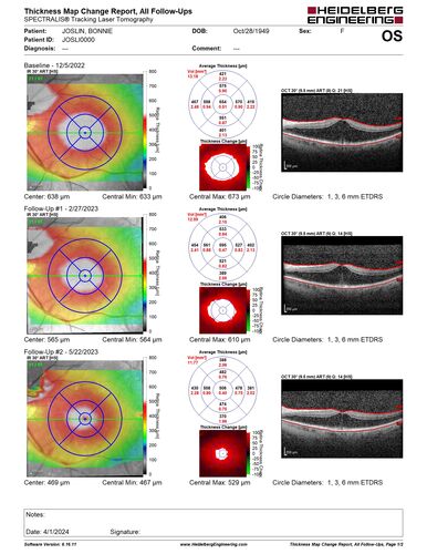 Macular schisis with no leakage on FA - Presumed Nerve pit maculopathy - NO THERAPY - BETTER
73-year old female.  Had treatment trial with Eylea with no benefit (4 months).  Vision is 20/32 in left eye and has remained there (with a dense cataract).
