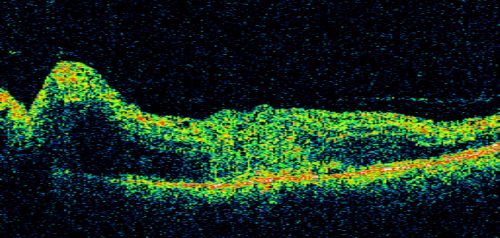 Atypical Neuroretinitis - ?Ischemic - ?Paraneoplastic - Line Scan OS Shows Nerve and Retinal Edema
74-year-old woman has stage 4 non-small cell lung carcinoma decreasing vision in the left eye for at least the last two weeks, VA 10/200. Trace APD OS.  No pain
Schlüsselwörter: swollen nerve;aion;neuroretinitis;paraneoplastic