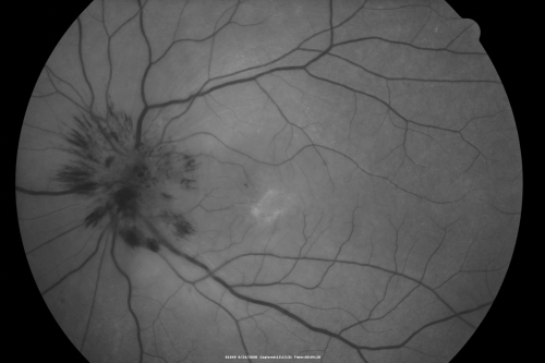 Atypical Neuroretinitis - ?Ischemic - ?Paraneoplastic - Red Free Photo Shows Optic Nerve Telangiectasis
74-year-old woman has stage 4 non-small cell lung carcinoma decreasing vision in the left eye for at least the last two weeks, VA 10/200. Trace APD OS.  No pain
Mots-clés: swollen nerve;aion;neuroretinitis;paraneoplastic