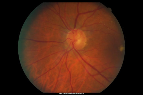 Atypical Neuroretinitis - ?Ischemic - ?Paraneoplastic Fundus Photo 1 year after initial episode VA 20/200
No treatment was done and the nerve swelling subsided over about 6 months.  This photo is taken one year after the ones showing swelling.  There is still a trace APD.
Schlüsselwörter: swollen nerve;aion;neuroretinitis;paraneoplastic