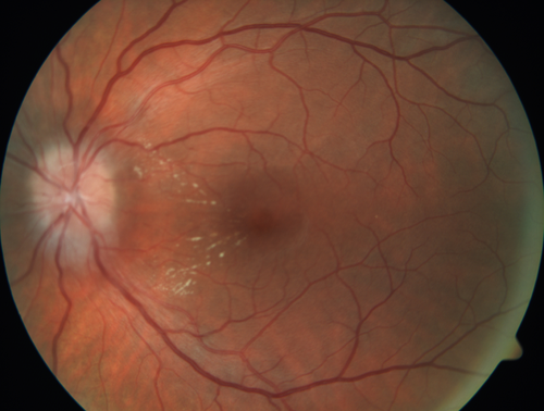 Neuroretinitis Left Eye
29 year old female - The left eye blurred up and she had double vision back in 2/2019 and March.  It has gradually improved so this past month the vision in the left eye is getting better.  Her MRI scan of her orbits with and without contrast was normal.  She had no pain in the eye with or without eye movement when the vision was blurred.  She has a cat for over 5 years. She has no exposure to kittens or stray cats and her cat is an indoor cat.  
VA OD: sc20/12 
VA OS: sc20/16-1 

All uveitis testing was negative (cat scratch, RPR, FTA-ABS, Sarcoid test, lyme test, TB testing.  She later developed recurrent uveitis without optic nerve involvement.
