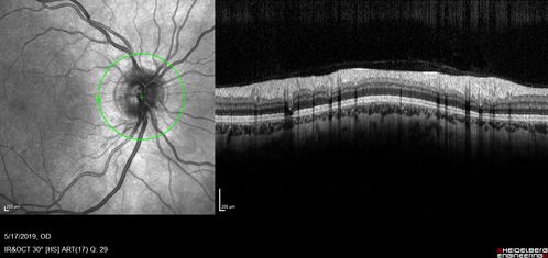 Neuroretinitis Left Eye
29 year old female - The left eye blurred up and she had double vision back in 2/2019 and March.  It has gradually improved so this past month the vision in the left eye is getting better.  Her MRI scan of her orbits with and without contrast was normal.  She had no pain in the eye with or without eye movement when the vision was blurred.  She has a cat for over 5 years. She has no exposure to kittens or stray cats and her cat is an indoor cat.  
VA OD: sc20/12 
VA OS: sc20/16-1 

All uveitis testing was negative (cat scratch, RPR, FTA-ABS, Sarcoid test, lyme test, TB testing.  She later developed recurrent uveitis without optic nerve involvement.
