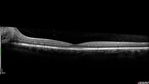 Neuroretinitis Left Eye
29 year old female - The left eye blurred up and she had double vision back in 2/2019 and March.  It has gradually improved so this past month the vision in the left eye is getting better.  Her MRI scan of her orbits with and without contrast was normal.  She had no pain in the eye with or without eye movement when the vision was blurred.  She has a cat for over 5 years. She has no exposure to kittens or stray cats and her cat is an indoor cat.  
VA OD: sc20/12 
VA OS: sc20/16-1 

All uveitis testing was negative (cat scratch, RPR, FTA-ABS, Sarcoid test, lyme test, TB testing.  She later developed recurrent uveitis without optic nerve involvement.
