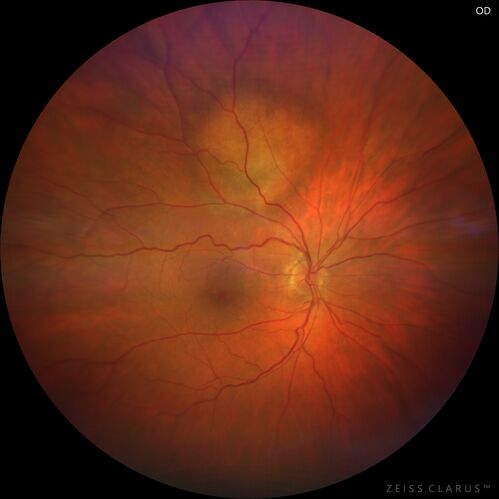 Amelanotic Choroidal Nevus
60 year old man.  Nevus is stable over 6 years.  Images are Photo, FAF, OCT, FA, ICG, and B-Scan
