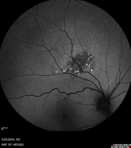 Amelanotic Choroidal Nevus
60 year old man.  Nevus is stable over 6 years.  Images are Photo, FAF, OCT, FA, ICG, and B-Scan
