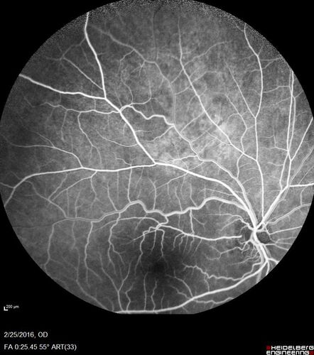 Amelanotic Choroidal Nevus
60 year old man.  Nevus is stable over 6 years.  Images are Photo, FAF, OCT, FA, ICG, and B-Scan
