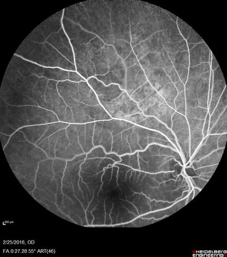 Amelanotic Choroidal Nevus
60 year old man.  Nevus is stable over 6 years.  Images are Photo, FAF, OCT, FA, ICG, and B-Scan
