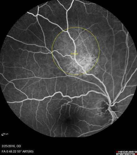 Amelanotic Choroidal Nevus
60 year old man.  Nevus is stable over 6 years.  Images are Photo, FAF, OCT, FA, ICG, and B-Scan
