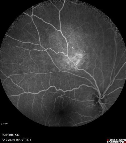 Amelanotic Choroidal Nevus
60 year old man.  Nevus is stable over 6 years.  Images are Photo, FAF, OCT, FA, ICG, and B-Scan
