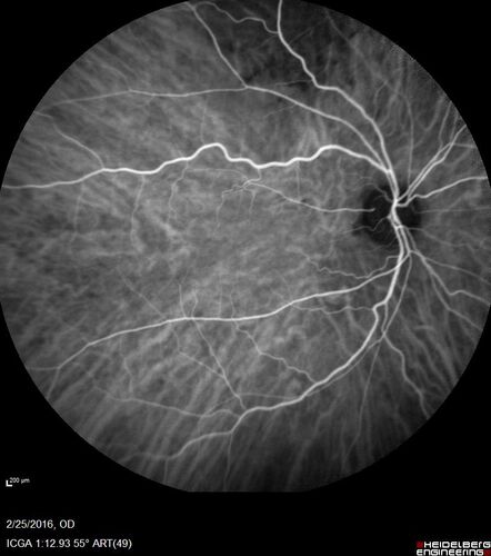Amelanotic Choroidal Nevus
60 year old man.  Nevus is stable over 6 years.  Images are Photo, FAF, OCT, FA, ICG, and B-Scan
