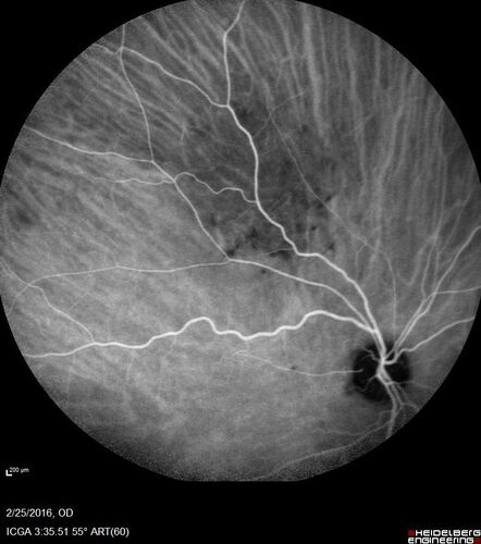 Amelanotic Choroidal Nevus
60 year old man.  Nevus is stable over 6 years.  Images are Photo, FAF, OCT, FA, ICG, and B-Scan
