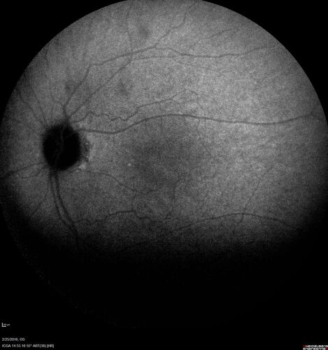 Amelanotic Choroidal Nevus
60 year old man.  Nevus is stable over 6 years.  Images are Photo, FAF, OCT, FA, ICG, and B-Scan
