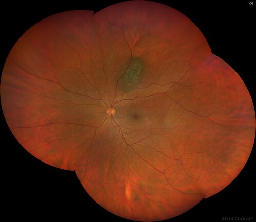 Choroidal nevus
Stable for 8 years.
