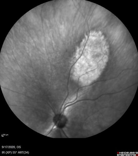 Choroidal nevus
Stable for 8 years.
