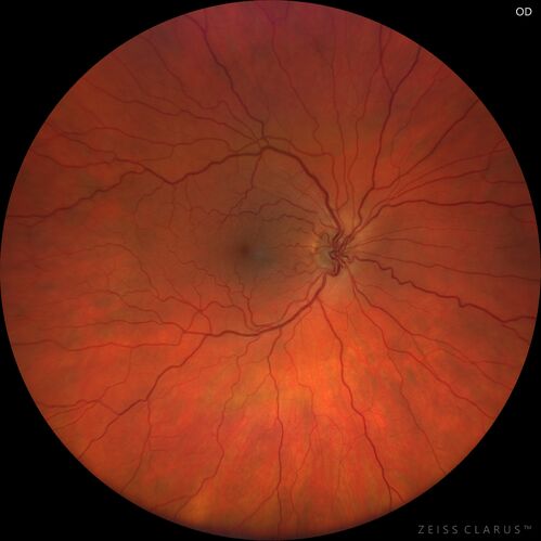 Large chronic choroidal nevus
Autofluorescence image shows guttering at the bottom of the lesion suggesting chronicity.  This was documented 23 years prior to these photos

