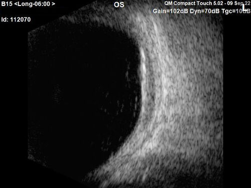 Large chronic choroidal nevus
Autofluorescence image shows guttering at the bottom of the lesion suggesting chronicity.  This was documented 23 years prior to these photos
