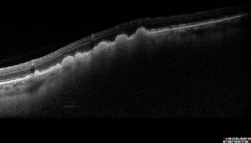 Choroidal Nevus with Drusen
Low risk choroidal nevus with many overlying drusen
