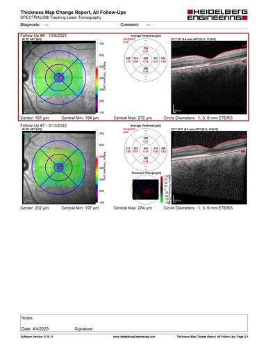 Central Serous Chorioretinopathy - Expanding hot spot - photodynamic laser
35 year old man with acute central serous chorioretinopathy.  The fluid got better then worse and the patient was treated with full strength juxtafoveal PDT and then got better.

