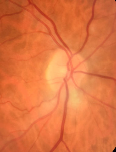 Myelinated Nerve Fiber Layer - Optic Nerve
Right eye subtle and inferior - left eye obvious
