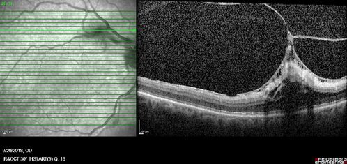 Non-central vitreomacular traction
