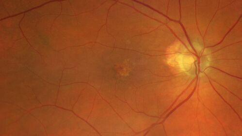 Non-exudative wet AMD - OCT angiogram
85 year old female with minimal visual complaints. 
VA OD: sc20/80+1 PHNI NccJ3
VA OS: sc20/40-2 PH20/32+1 NccJ3
IOP: TP: OD:14 OS:16
