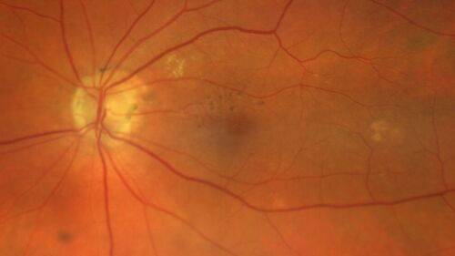 Non-exudative wet AMD - OCT angiogram
85 year old female with minimal visual complaints. 
VA OD: sc20/80+1 PHNI NccJ3
VA OS: sc20/40-2 PH20/32+1 NccJ3
IOP: TP: OD:14 OS:16
