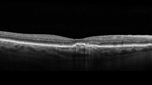 Non-exudative wet AMD - OCT angiogram
85 year old female with minimal visual complaints. 
VA OD: sc20/80+1 PHNI NccJ3
VA OS: sc20/40-2 PH20/32+1 NccJ3
IOP: TP: OD:14 OS:16
