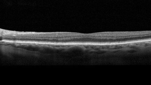 Non-exudative wet AMD - OCT angiogram
85 year old female with minimal visual complaints. 
VA OD: sc20/80+1 PHNI NccJ3
VA OS: sc20/40-2 PH20/32+1 NccJ3
IOP: TP: OD:14 OS:16
