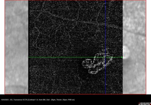 Non-exudative wet AMD - OCT angiogram
85 year old female with minimal visual complaints. 
VA OD: sc20/80+1 PHNI NccJ3
VA OS: sc20/40-2 PH20/32+1 NccJ3
IOP: TP: OD:14 OS:16
