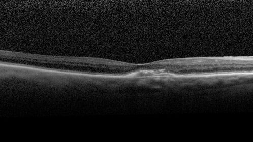 Non-exudative wet AMD - OCT angiogram
85 year old female with minimal visual complaints. 
VA OD: sc20/80+1 PHNI NccJ3
VA OS: sc20/40-2 PH20/32+1 NccJ3
IOP: TP: OD:14 OS:16
