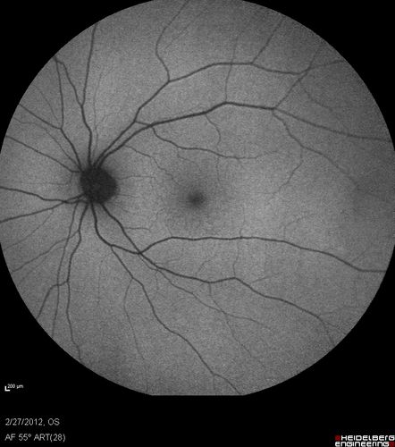 Normal Fundus Autofluorescence
48-year-old woman has had a problem with light and dark adaptations.  She notices when she sees a point source of light like a cell phone in a dimly lit room and then she turns the cell phone off, that subsequently her vision is very dark until she goes back into a well lighted area.  OD 20/20,  OS 20/25. 
