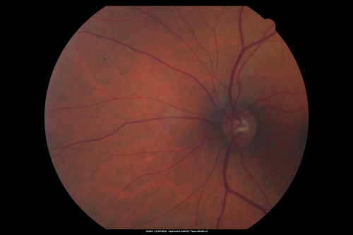 Normal Fellow Eye
65-year-old woman has pseudoretinitis pigmentosa in the right eye only, most likely from acute zonal occult outer retinopathy.   OD 20/25,  OS 20/25
