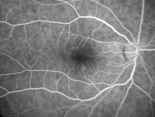 69 Year Old Woman Normal Fluorescein Angiogram
69-year-old woman   OD 20/50 - OS  20/30	ATYPICAL PHOTOPSIAS

