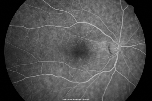 69 Year Old Woman Normal Fluorescein Angiogram
69-year-old woman   OD 20/50 - OS  20/30	ATYPICAL PHOTOPSIAS

