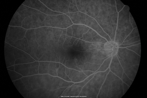 69 Year Old Woman Normal Fluorescein Angiogram
69-year-old woman   OD 20/50 - OS  20/30	ATYPICAL PHOTOPSIAS

