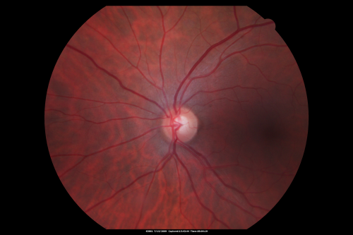 69 Year Old Woman Normal Fundus Photograph
69-year-old woman   OD 20/50 - OS  20/30	ATYPICAL PHOTOPSIAS

