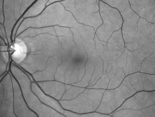 69 Year Old Woman Normal Red Free
69-year-old woman   OD 20/50 - OS  20/30	ATYPICAL PHOTOPSIAS

