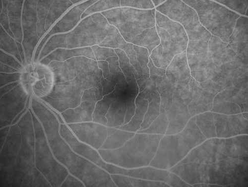 69 Year Old Woman Normal FA
69-year-old woman   OD 20/50 - OS  20/30	ATYPICAL PHOTOPSIAS


