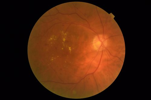 Diabetic Macular Edema with Exudates
Patient did not want injection therapy and did well with laser
