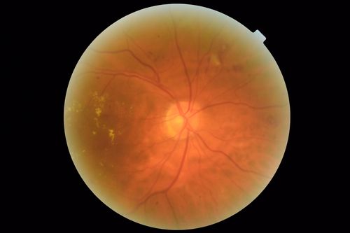 Diabetic Macular Edema with Exudates
Patient did not want injection therapy and did well with laser
