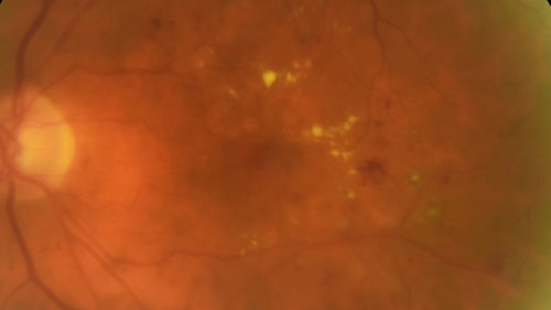 Diabetic Macular Edema with Exudates
Patient did not want injection therapy and did well with laser
